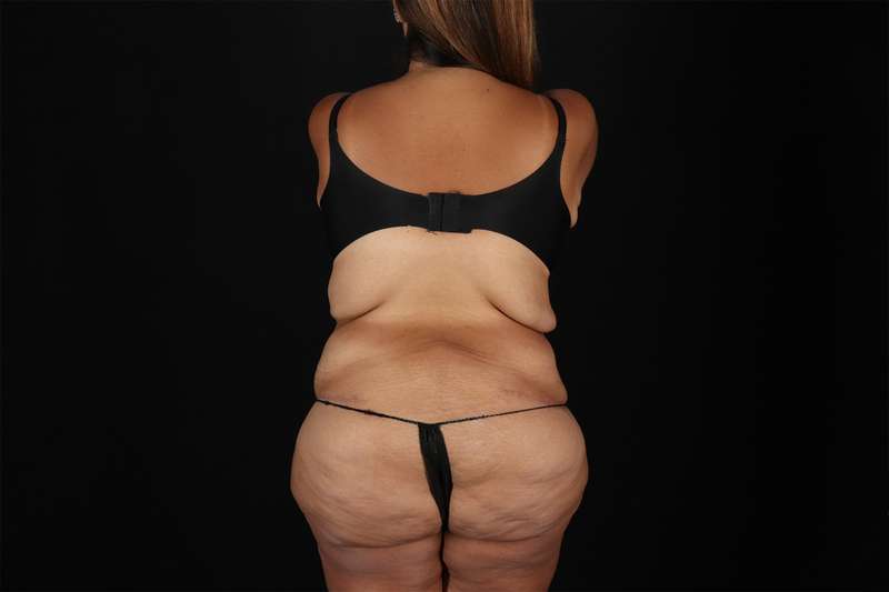 Fleur De Lis Tummy Tuck Before & After Patient #4366