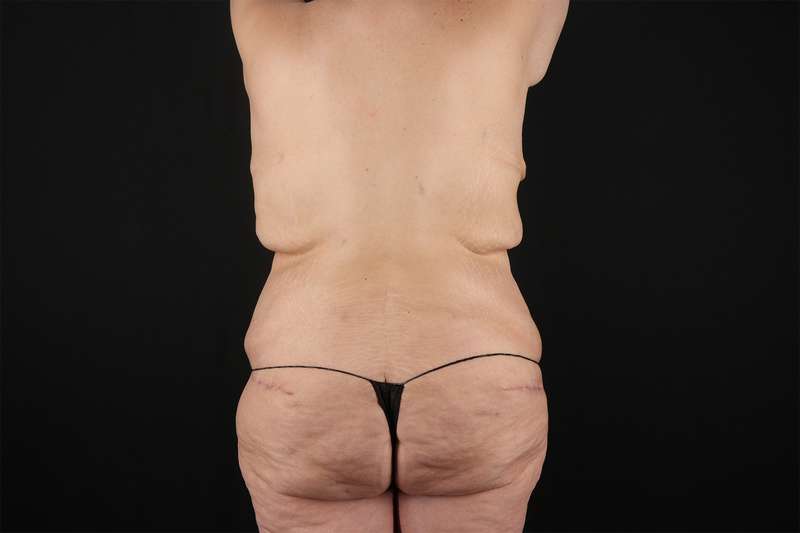 Fleur De Lis Tummy Tuck Before & After Patient #4379