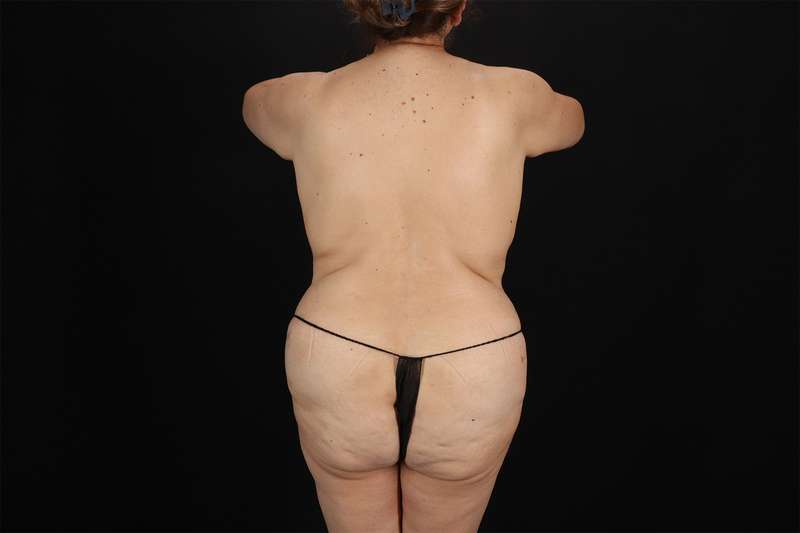 Fleur De Lis Tummy Tuck Before & After Patient #4392