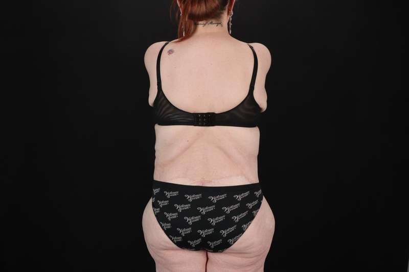 Fleur De Lis Circumferential Body Lift Before & After Patient #4236