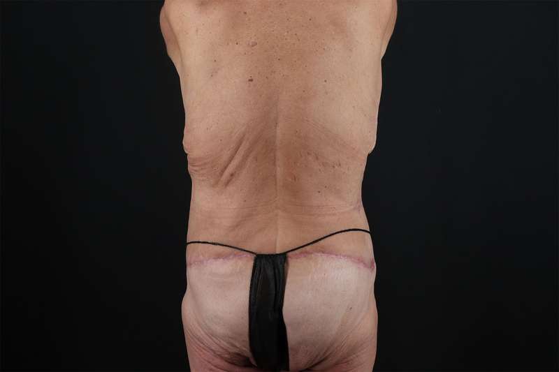 Fleur De Lis Circumferential Body Lift Before & After Patient #4262