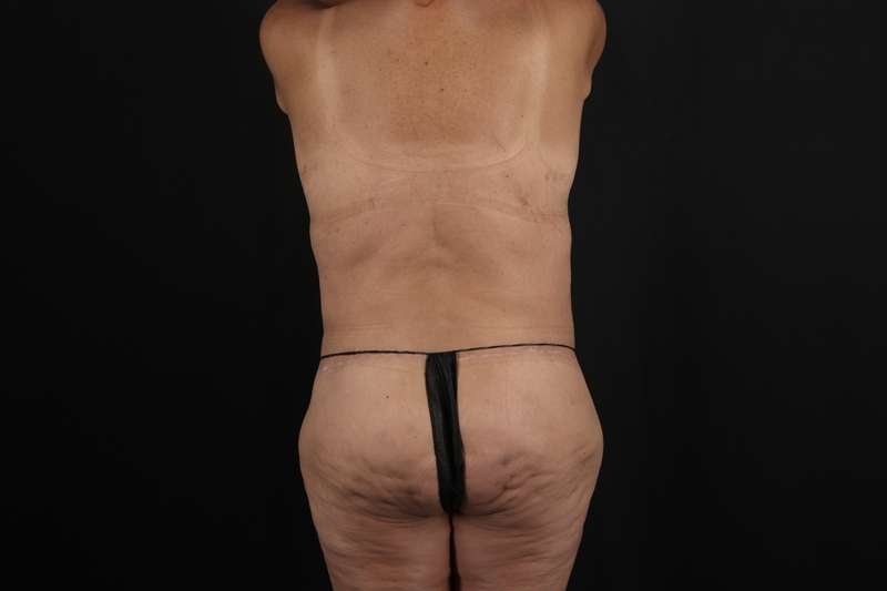 Fleur De Lis Circumferential Body Lift Before & After Patient #4275