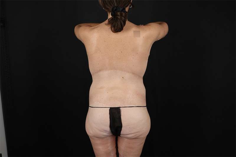 Fleur De Lis Circumferential Body Lift Before & After Patient #4288