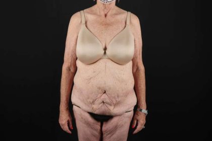 Fleur De Lis Tummy Tuck Before & After Patient #4327