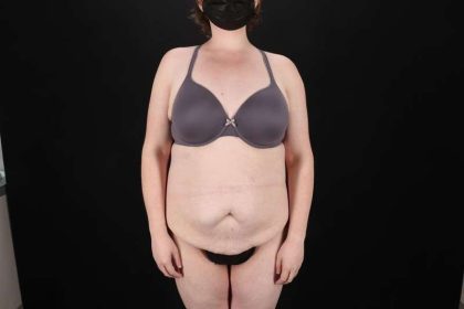 Fleur De Lis Tummy Tuck Before & After Patient #4340