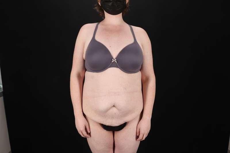 Fleur De Lis Tummy Tuck Before & After Patient #4340
