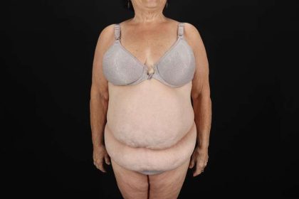Fleur De Lis Tummy Tuck Before & After Patient #4353