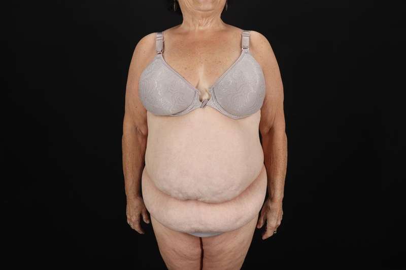Fleur De Lis Tummy Tuck Before & After Patient #4353