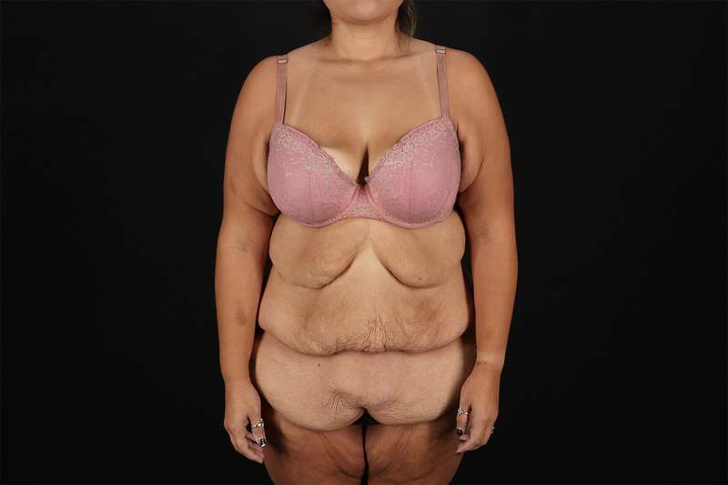 Fleur De Lis Tummy Tuck Before & After Patient #4366