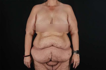 Fleur De Lis Tummy Tuck Before & After Patient #4379