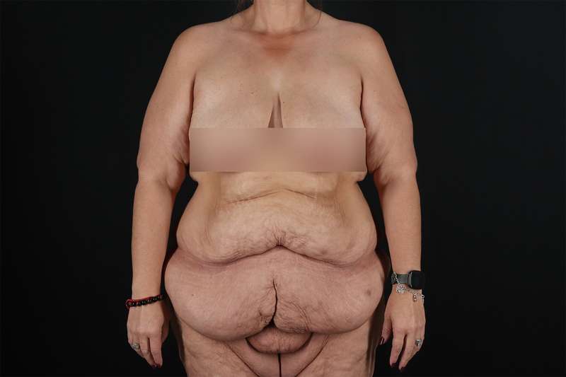 Fleur De Lis Tummy Tuck Before & After Patient #4379