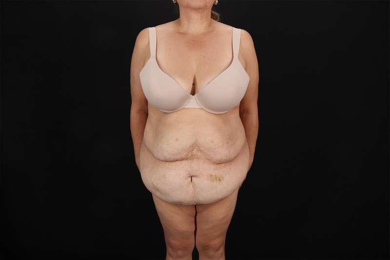 Fleur De Lis Tummy Tuck Before & After Patient #4392
