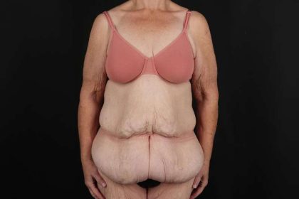 Fleur De Lis Circumferential Body Lift Before & After Patient #4210