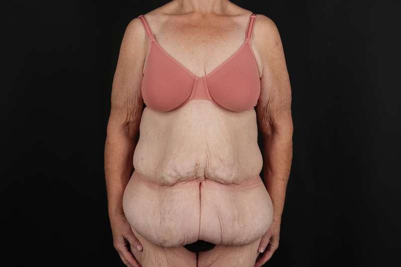 Fleur De Lis Circumferential Body Lift Before & After Patient #4210