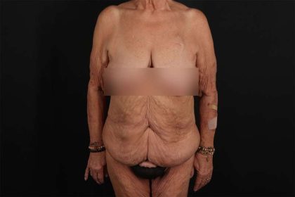 Fleur De Lis Circumferential Body Lift Before & After Patient #4262