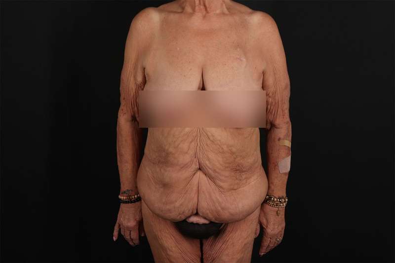 Fleur De Lis Circumferential Body Lift Before & After Patient #4262