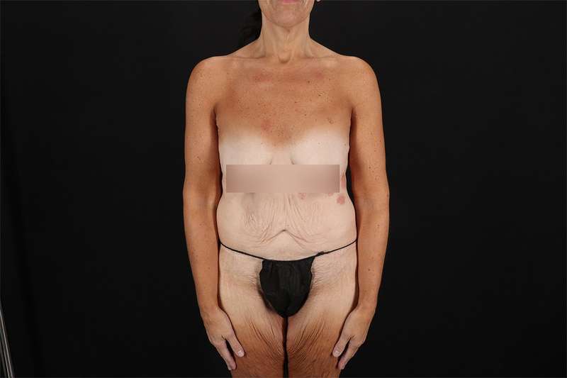 Fleur De Lis Circumferential Body Lift Before & After Patient #4288