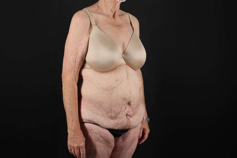 Fleur De Lis Tummy Tuck Before & After Patient #4327