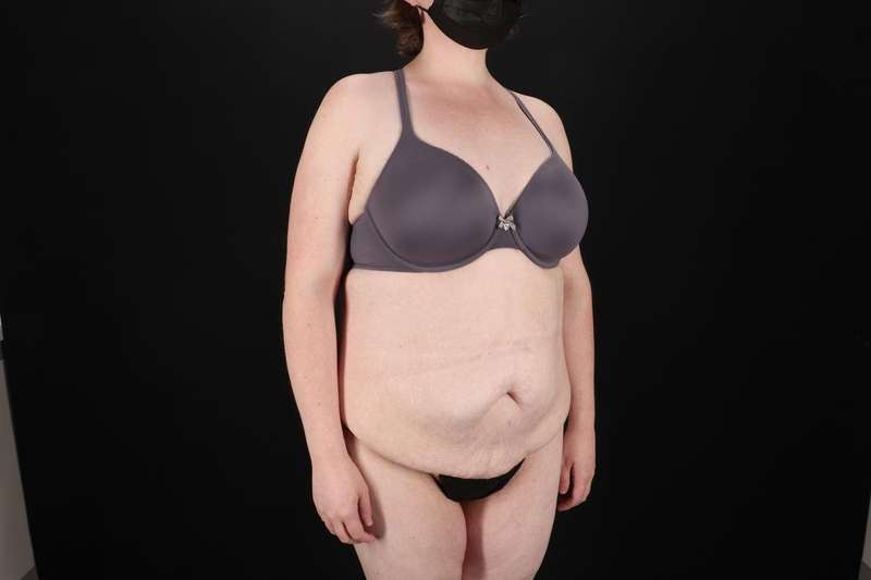 Fleur De Lis Tummy Tuck Before & After Patient #4340