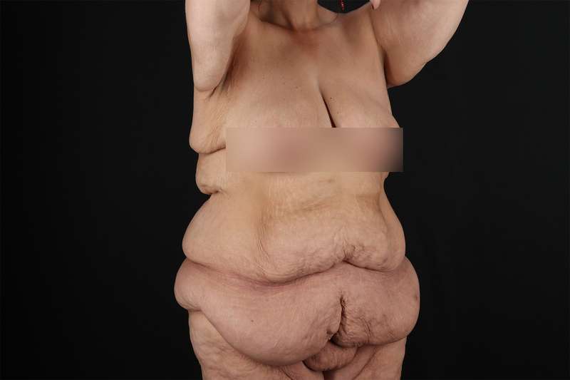 Fleur De Lis Tummy Tuck Before & After Patient #4379