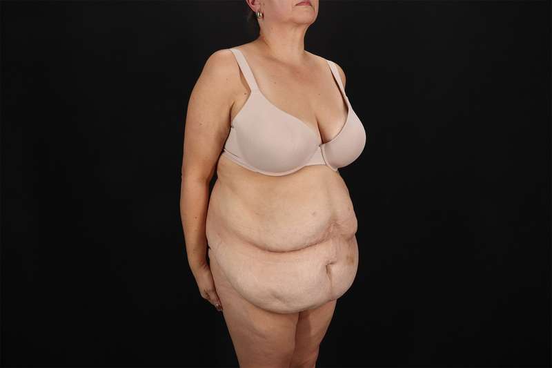 Fleur De Lis Tummy Tuck Before & After Patient #4392