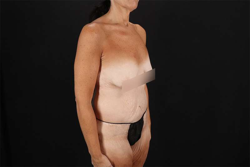 Fleur De Lis Circumferential Body Lift Before & After Patient #4288