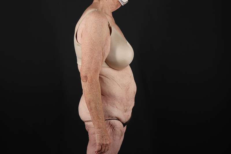 Fleur De Lis Tummy Tuck Before & After Patient #4327