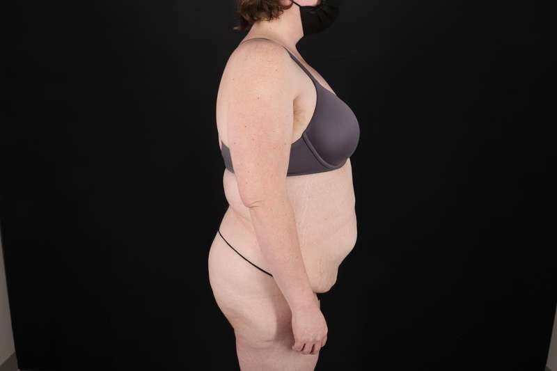 Fleur De Lis Tummy Tuck Before & After Patient #4340