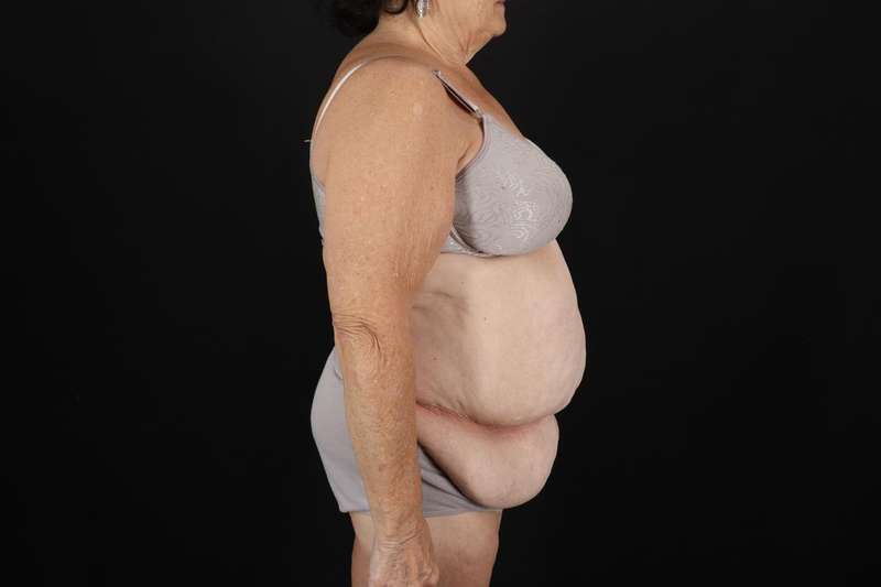 Fleur De Lis Tummy Tuck Before & After Patient #4353