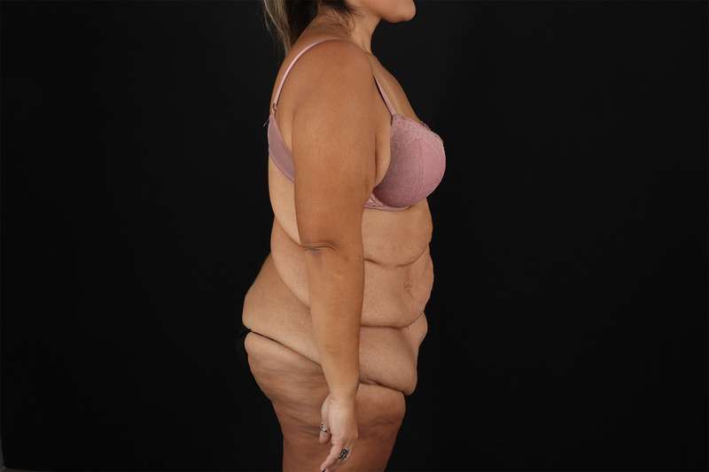 Fleur De Lis Tummy Tuck Before & After Patient #4366