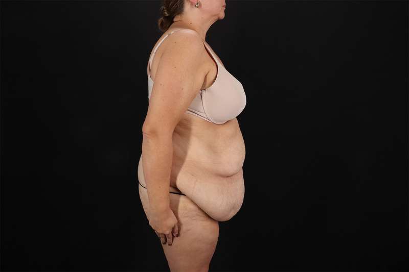 Fleur De Lis Tummy Tuck Before & After Patient #4392