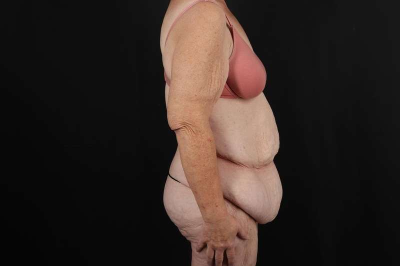 Fleur De Lis Circumferential Body Lift Before & After Patient #4210