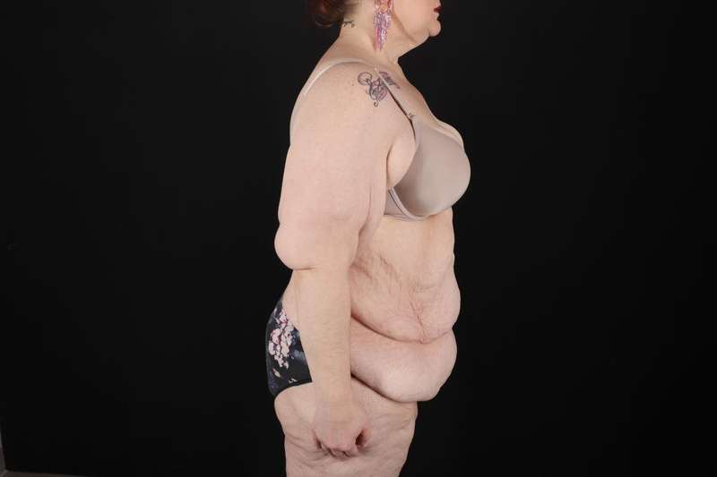 Fleur De Lis Circumferential Body Lift Before & After Patient #4236
