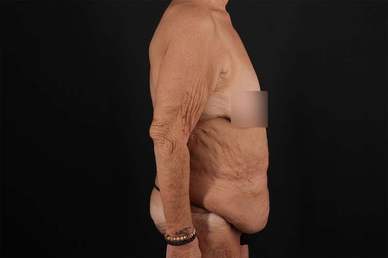 Fleur De Lis Circumferential Body Lift Before & After Patient #4262