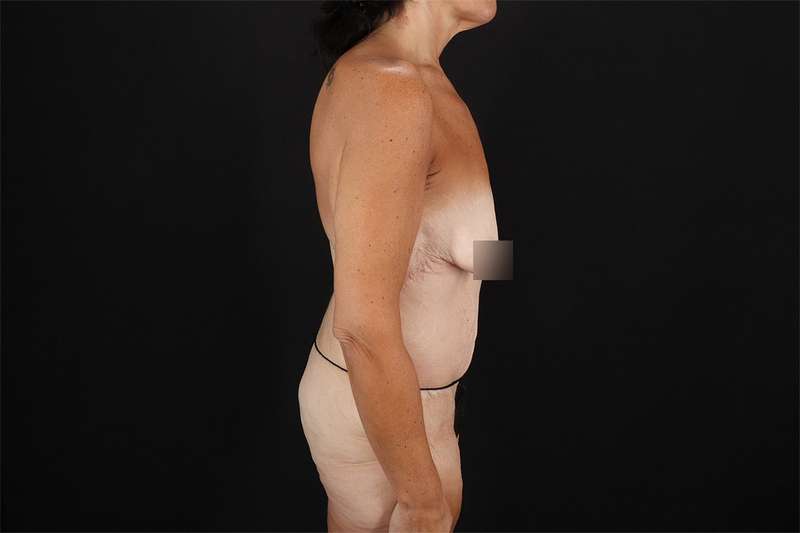 Fleur De Lis Circumferential Body Lift Before & After Patient #4288