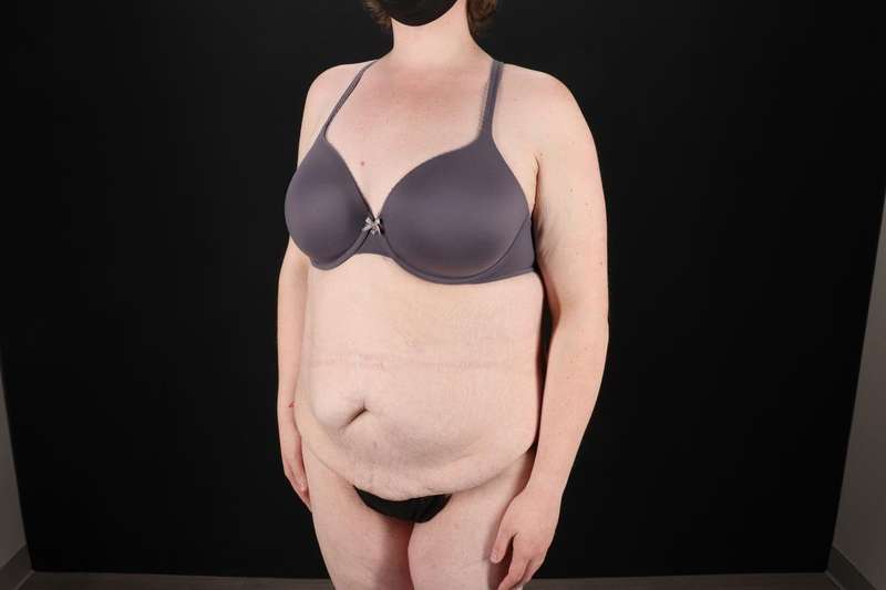 Fleur De Lis Tummy Tuck Before & After Patient #4340