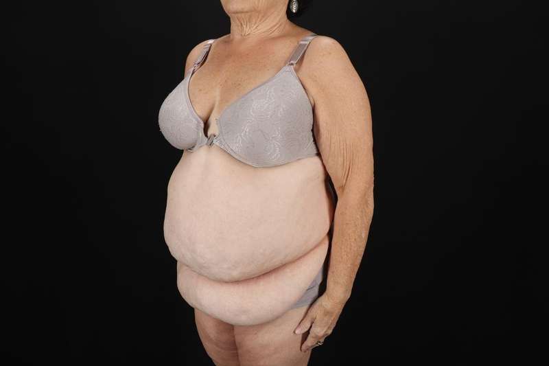 Fleur De Lis Tummy Tuck Before & After Patient #4353
