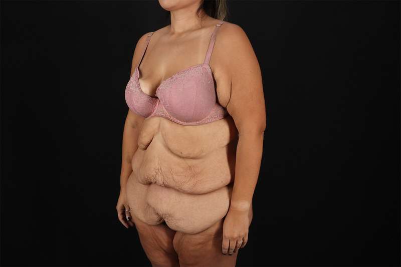 Fleur De Lis Tummy Tuck Before & After Patient #4366