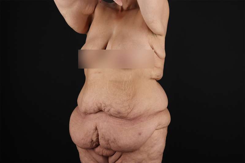 Fleur De Lis Tummy Tuck Before & After Patient #4379