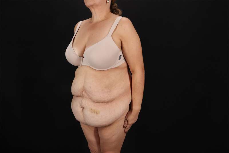 Fleur De Lis Tummy Tuck Before & After Patient #4392