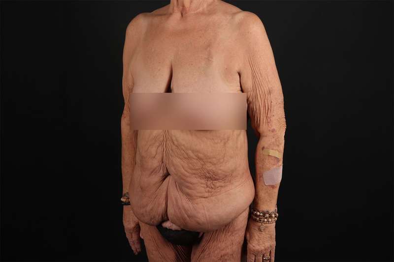 Fleur De Lis Circumferential Body Lift Before & After Patient #4262