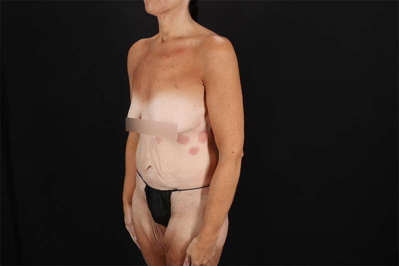 Fleur De Lis Circumferential Body Lift Before & After Patient #4288