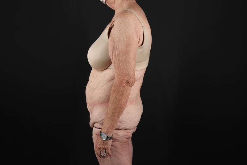 Fleur De Lis Tummy Tuck Before & After Patient #4327
