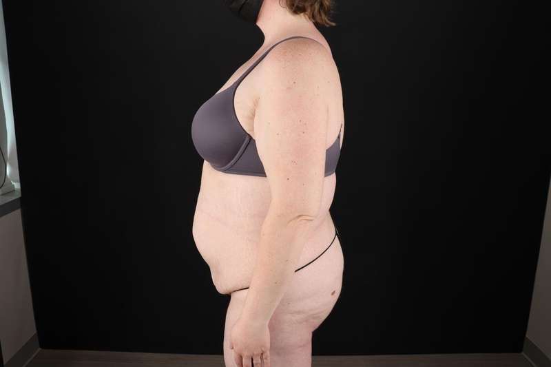 Fleur De Lis Tummy Tuck Before & After Patient #4340