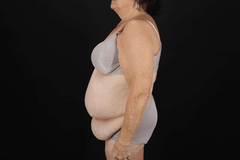 Fleur De Lis Tummy Tuck Before & After Patient #4353