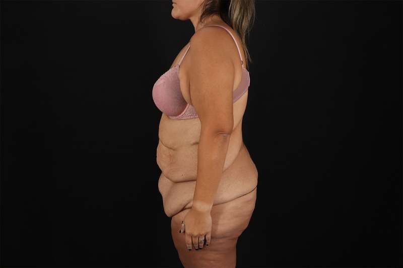 Fleur De Lis Tummy Tuck Before & After Patient #4366