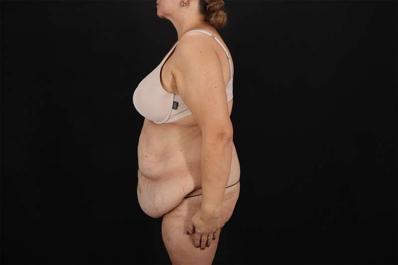 Fleur De Lis Tummy Tuck Before & After Patient #4392