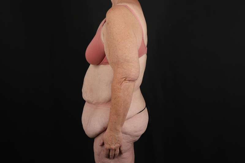 Fleur De Lis Circumferential Body Lift Before & After Patient #4210