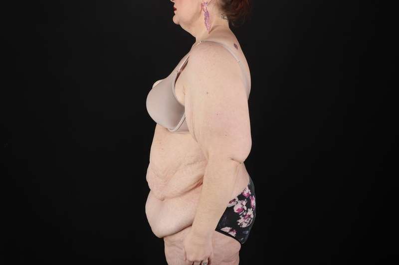 Fleur De Lis Circumferential Body Lift Before & After Patient #4236