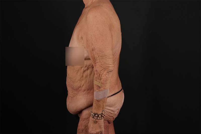Fleur De Lis Circumferential Body Lift Before & After Patient #4262